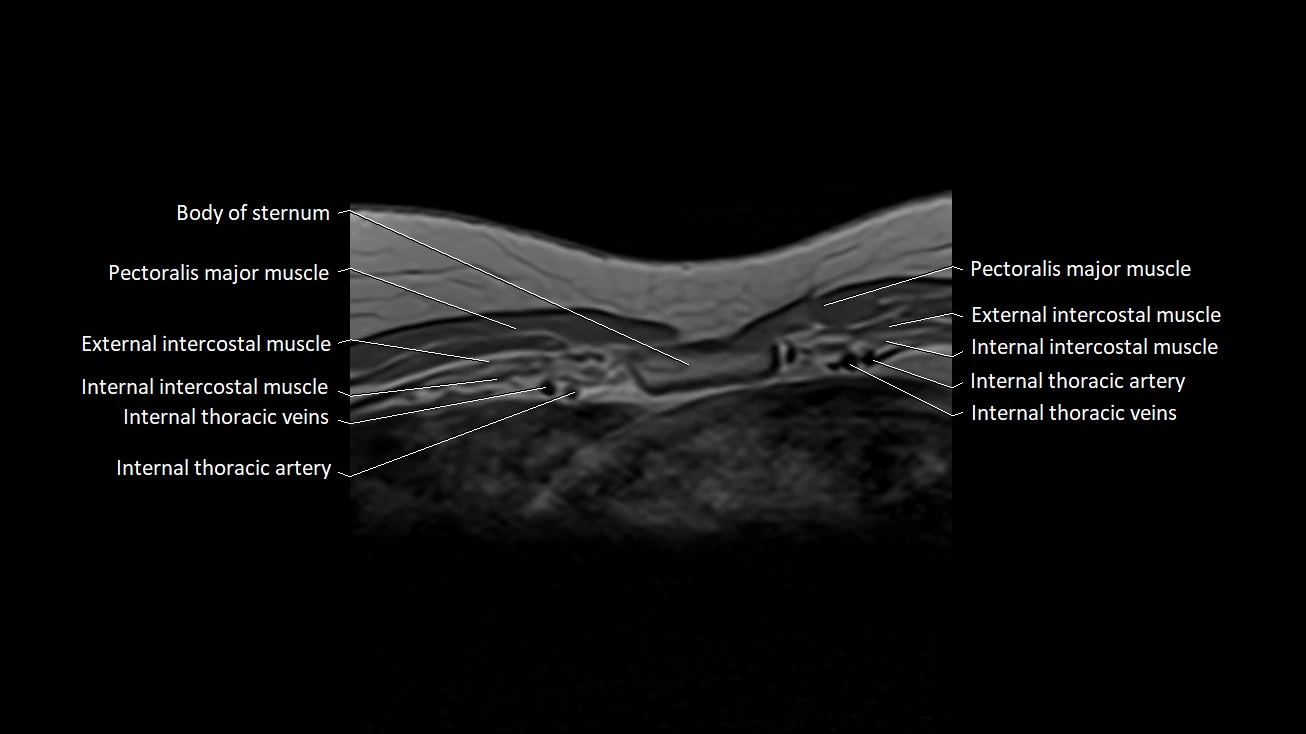 MRI sternum and sternoclavicular joint labeled axial anatomy image 21.webp